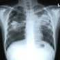 Viability of Homeopathic treatment in case of tuberculosis