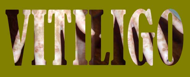 Vitiligo :: Skin Leucoderma – vitiligo – Sepia